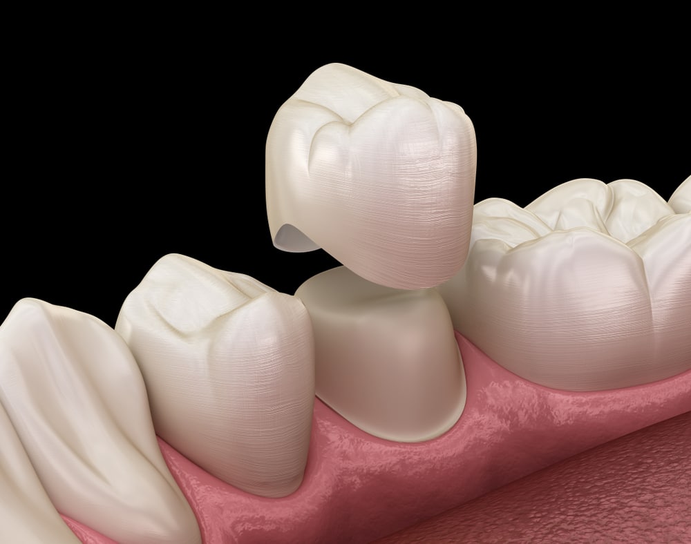 Clinton dental crowns Dr. David Henry Dr. Stephen Greer. Northside Dental Group General, Cosmetic, Restorative, Pediatric Dentistry dentist in Clinton MS 39056