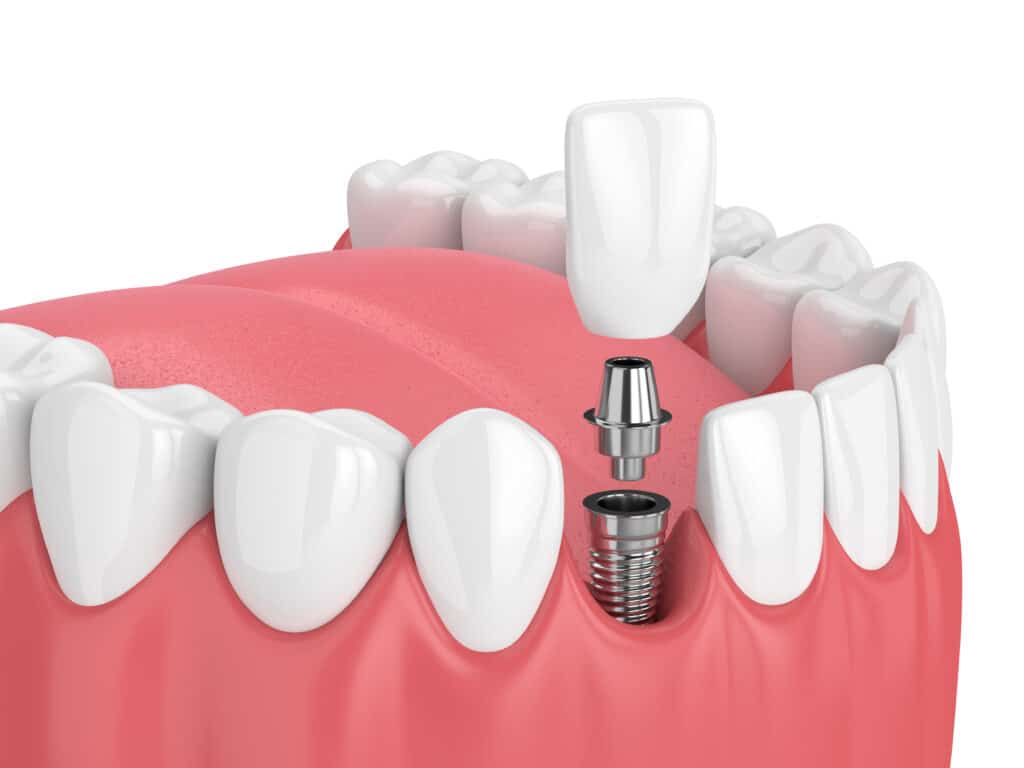 single tooth implant clinton