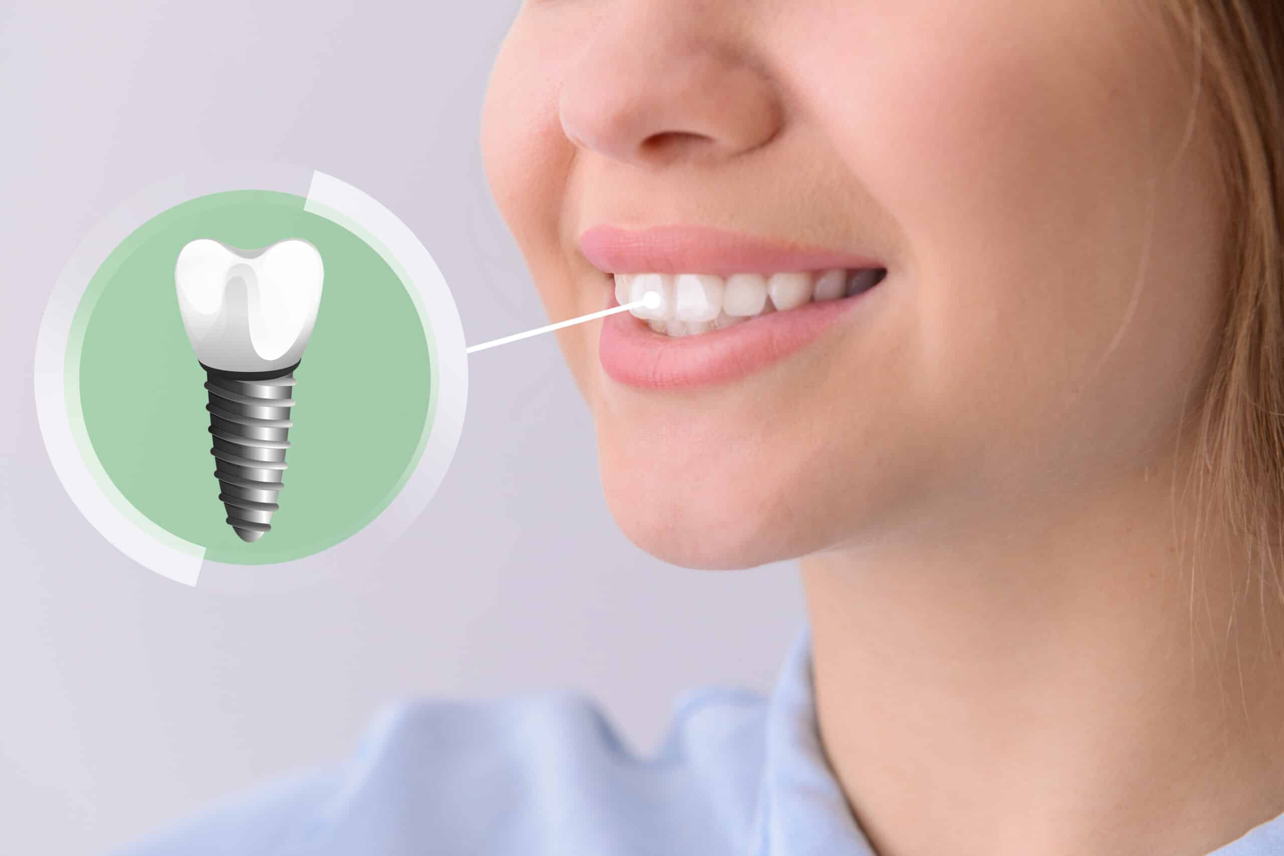 single tooth implant near me